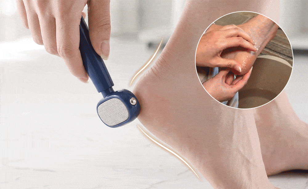 Foot callus remover